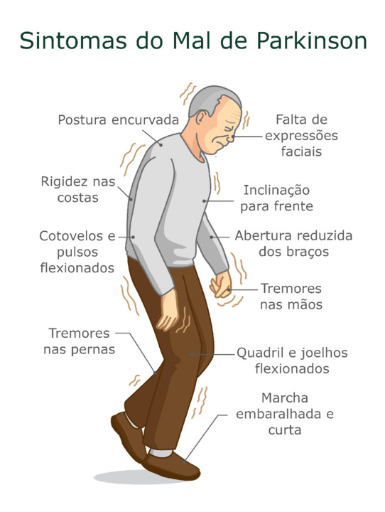 mal-de-parkinson-sintomas-763720675.jpg